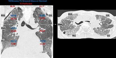 Allogeneic Hematopoietic Stem Cell Transplantation After Prior Lung Transplantation for Hereditary Pulmonary Alveolar Proteinosis: A Case Report